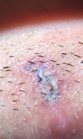 术后10天，皮下内缝合可吸收线外漏